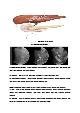 신규간호사도 이해할 수 있게 만든 담관염 자료(시술 및 이미지)   (4 페이지)